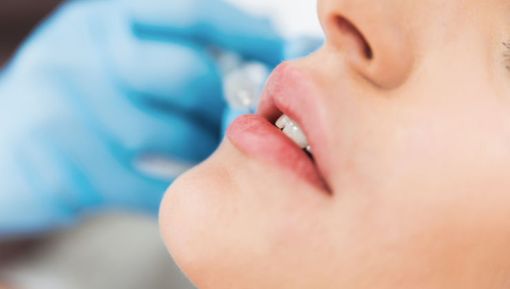 acido hialur&oacute;nico en labios