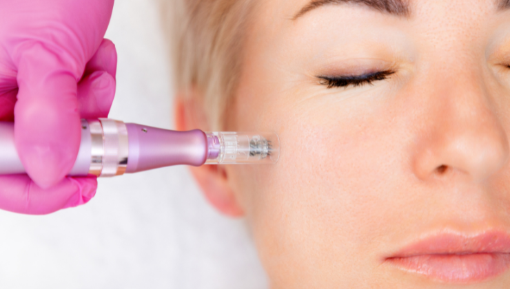 qu&eacute; es el Microneedling