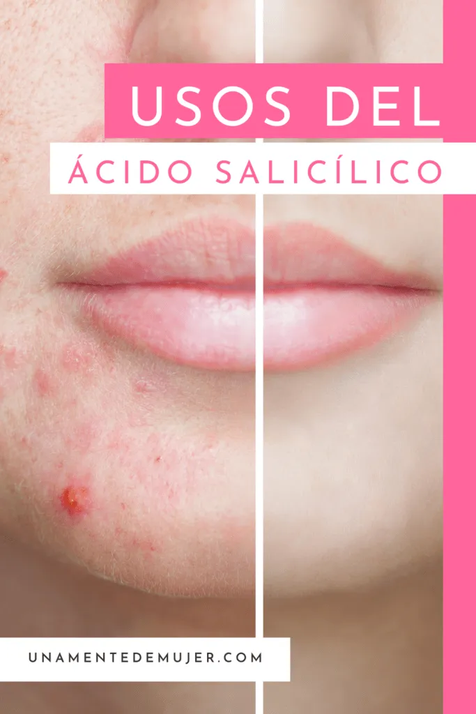 Usos Del Acido Salicilico Para El Acne