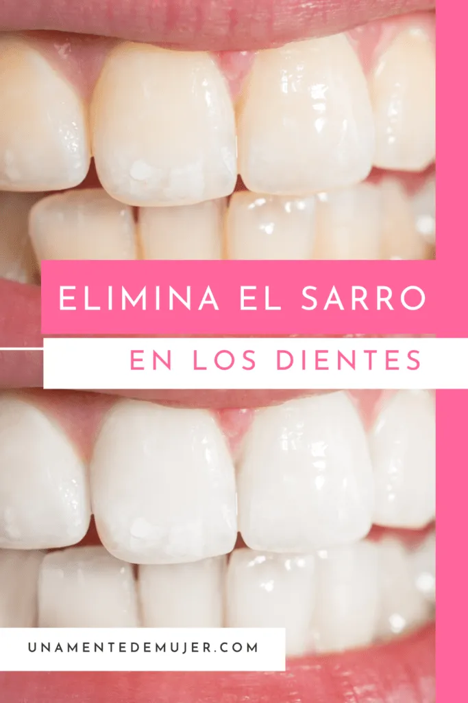 Sarro En Los Dientes Como Quitarlo 1