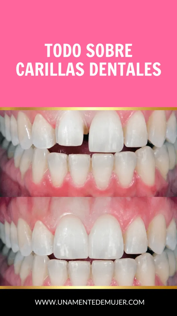 carillas dentales antes y despu&eacute;s
