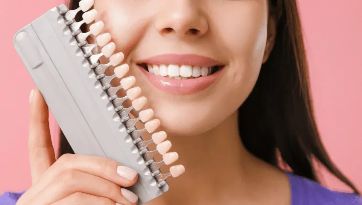 carillas dentales